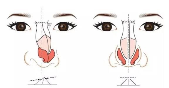 唐冬生医师讲解 鼻翼缩小术究竟有没有风险？