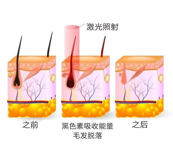 激光脱毛会影响排汗吗？